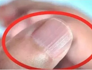 2024海角官网首页厂家分析手指甲有竖纹的根本原因